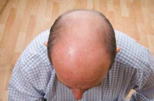 Do You Fear Baldness? Then Stop It From Happening!