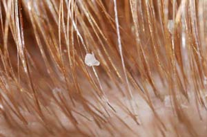 Fight Dandruff In Most Simple Ways!