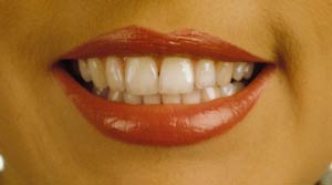 Want Million Dollar Perfect Smile-Dental Care!