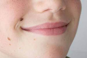 Can Kids Get Freckles?