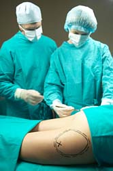 Liposuction For That Perfect Figure!