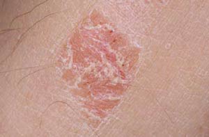 Do You Know What Psoriasis Is?