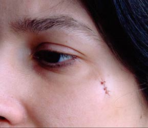 Scars-A Matter Of Cosmetic And Beauty Concern!