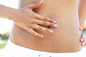 Do You Have Stretch Marks?