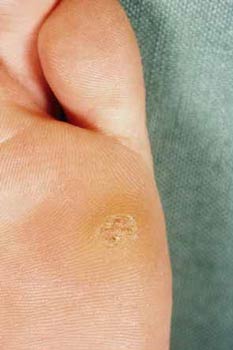 Are Warts Bothering You?