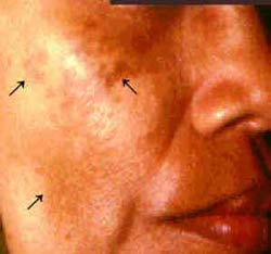 Find Out What is Melasma!