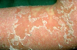 psoriasis treatment