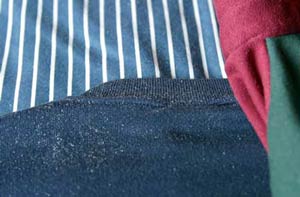 Worried About Flaky Scalp? Tips To Get Rid Of Dandruff!