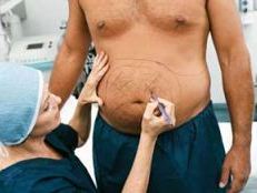 What’s this - Abdominoplasty or Tummy Tuck?