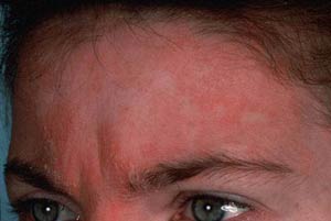 Know About Skin Rash Types!