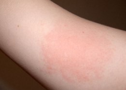 How Skin Allergy Can Be Devastating Condition?