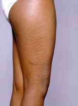 Prevent Your Skin From Stretch Marks! Tips For Unsightly Stretch Marks!