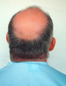 Are You Affected By Alopecia (Baldness)? Discover The Causes!