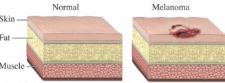 Brown Spots On Your Skin Can Lead To Melanoma