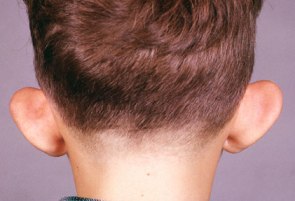 Otoplasty - A Surgical Procedure To Restructure The Deformity Of The Ear!