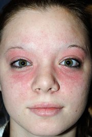 Suffering With Serious Skin Problems? Understand How Skin Infections Affect Your Body!