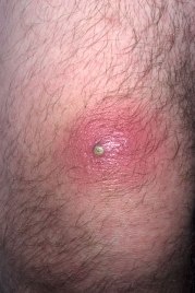 How To Cure Skin Abscess Naturally?