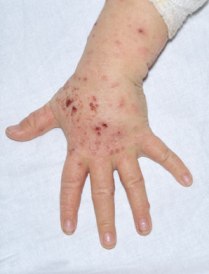 Protect Your Children From Atopic Eczema!