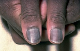 Different Ways To Treat Hyperpigmentation!