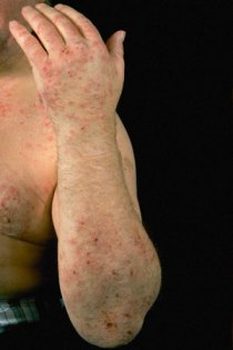 Are You Suffering With Itchy, Swollen Rashes On Your Skin? Know More About Skin Lesions!