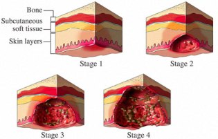 How Diet Plays A Major Role In Healing Skin Ulcers?