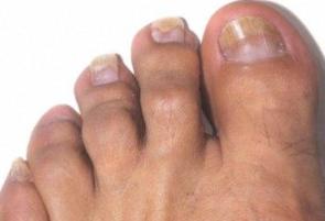 Proper Care For Your Nails Is Very Essential In Order To Avoid Nail Fungus!