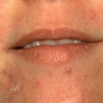 Are You Fed Up With Routine Rosacea Treatment? 