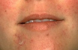 rosacea treatment
