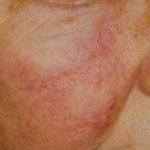 What’s This Rosacea?