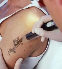 eliminating tattoo