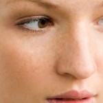 Can Anything Be Done To Remove Freckles?