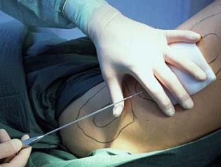 Liposuction