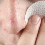 Bad Habits That Can Aggravate Acne