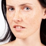 Give Your Freckles The Heave-Ho: How To Get Rid Of Freckles?