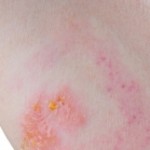 How To Prevent Viral Rashes?
