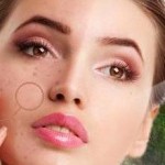 Natural Acne Treatment Option for Those Who Cannot Use Standard Drugs