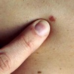 New Laser to Detect Skin Cancer Early