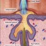 Laser Treatment for Acne Removal