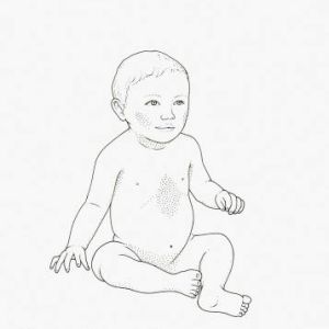 Baby Skin Rash
