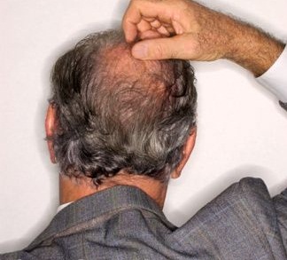 Alopecia Areata Treatment