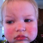 Baby skin rash