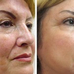 Get a Fresh Start with Laser Skin Resurfacing