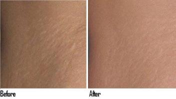 Laser Removal of Stretch Marks
