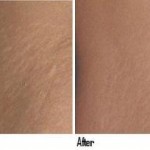 Laser Removal of Stretch Marks