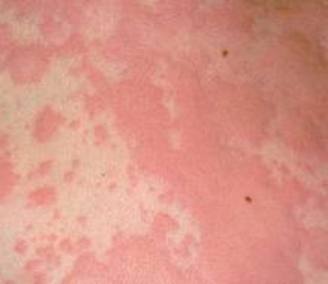 Learn About Cause of Hives