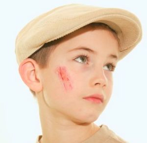 Removal of Types of scars