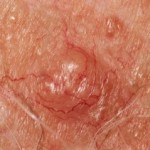 New Drug to Stop Metastasis of Skin Cancer Found