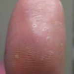 Skin Peeling on Fingertips