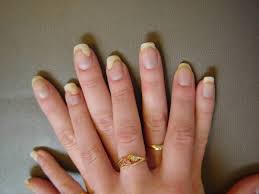 Nail Psoriasis