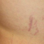 Stretch marks
